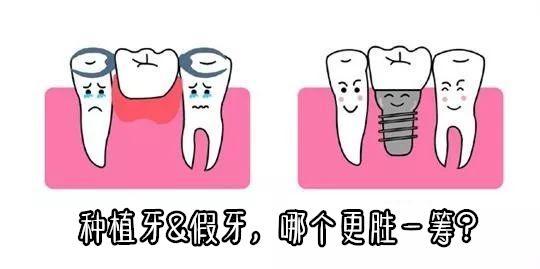 种植牙vs固定桥,到底哪个更好? - 知乎