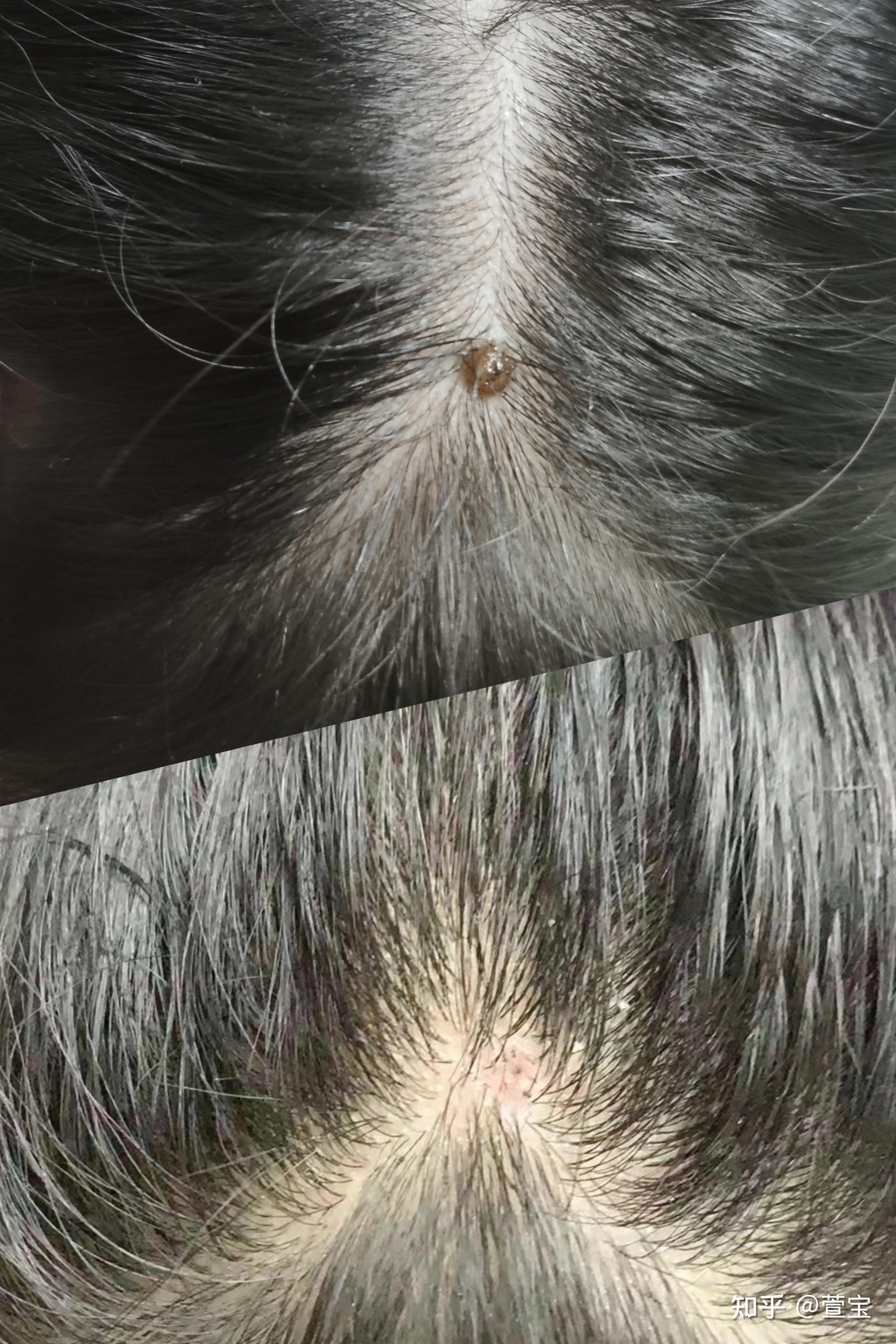 头上长瘊子?先别去医院动刀!试下这个方法