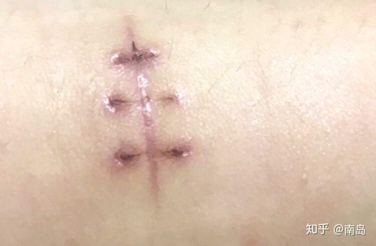 额头缝针后的疤痕怎么办