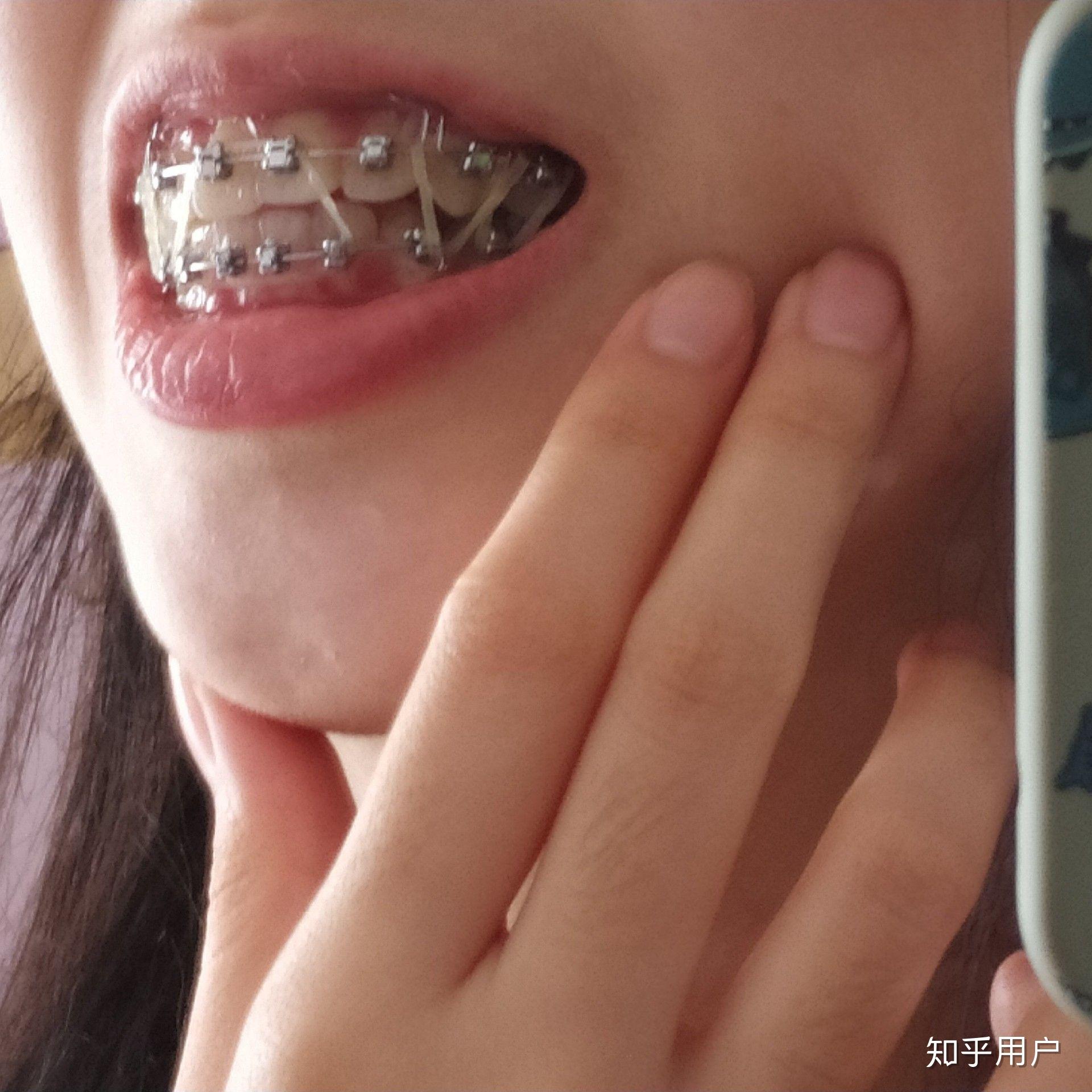 来说说牙齿矫正挂小皮筋是什么感受
