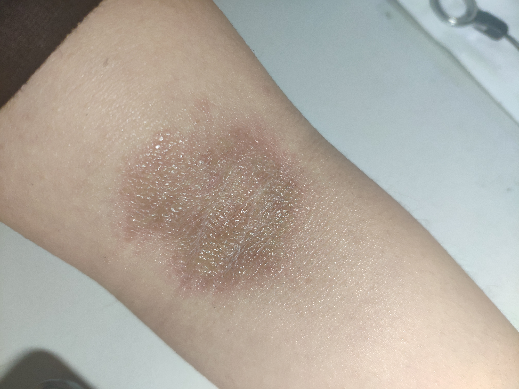 神经性皮炎怎么办求解啊