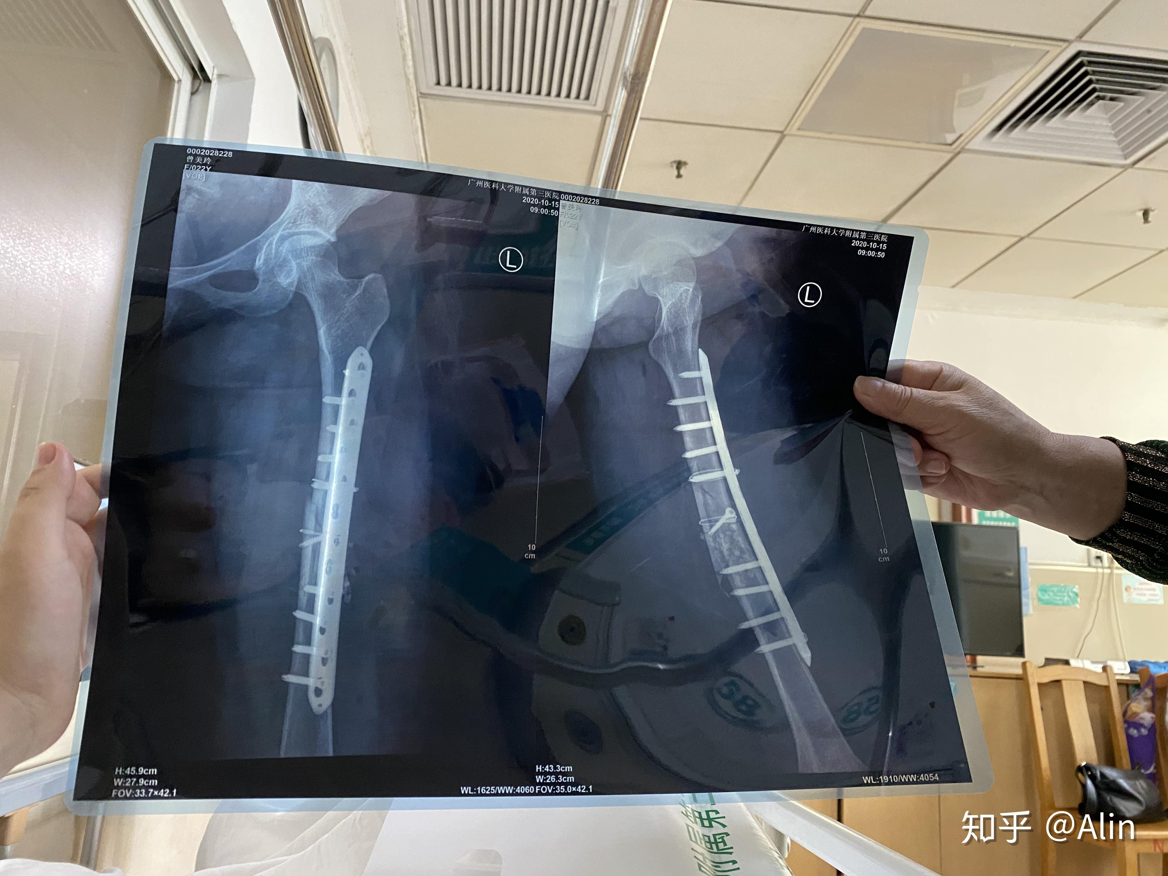 我大腿骨折,手术打了钢钉钢板.现在已经拆线,多久才能下地.