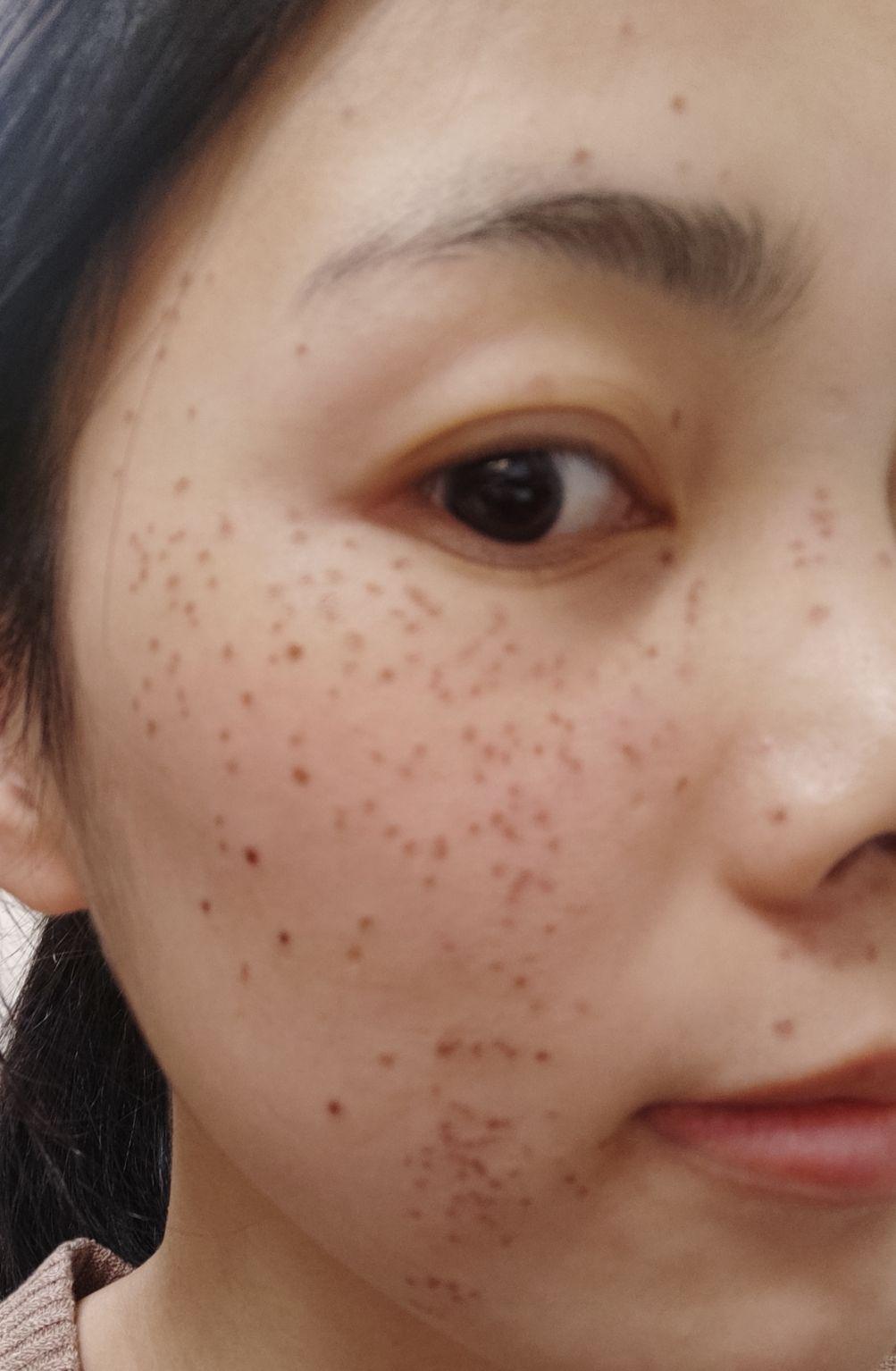 点斑后的恢复期? - 知乎