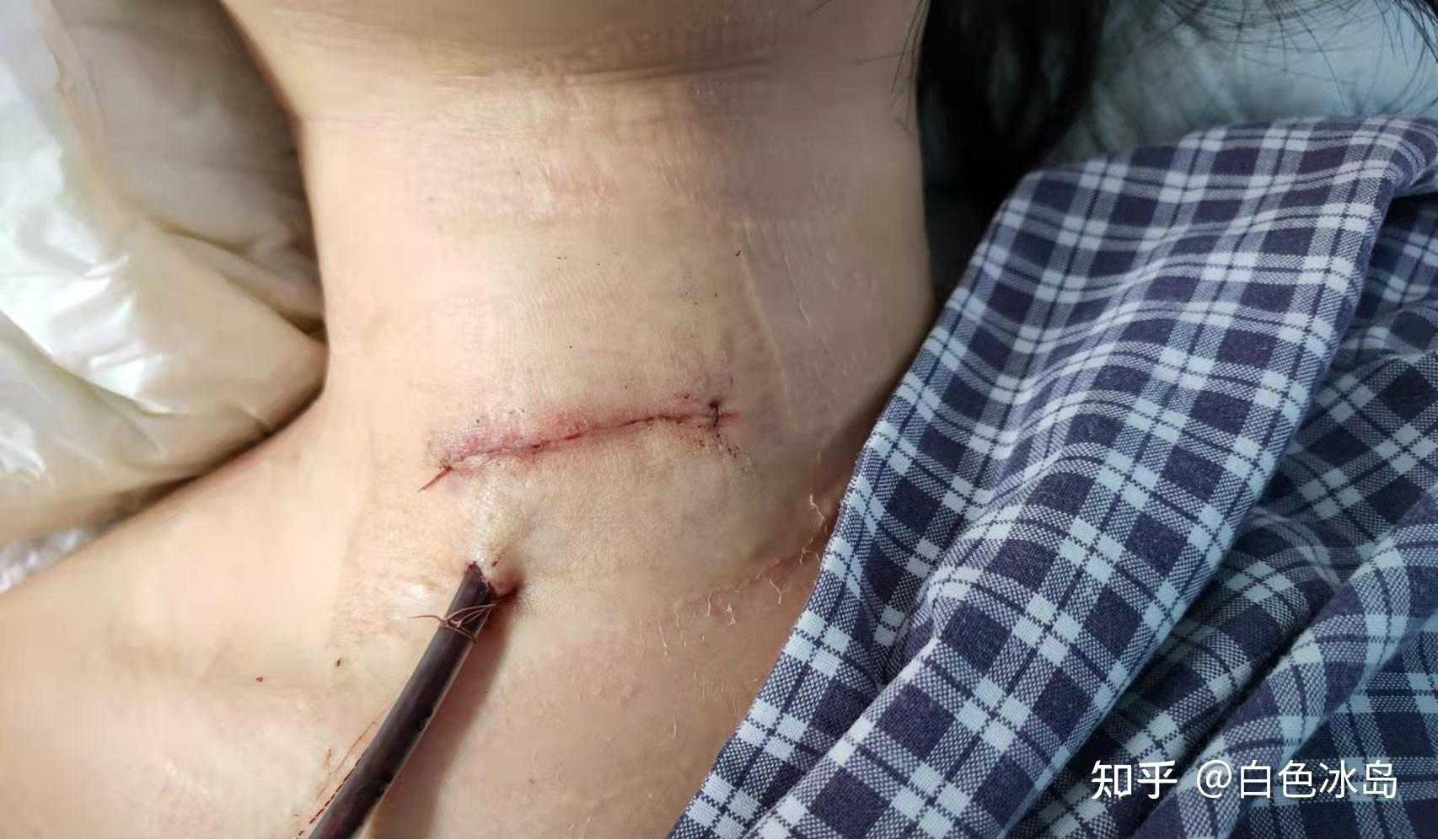年纪轻轻患上颈椎病是什么体验