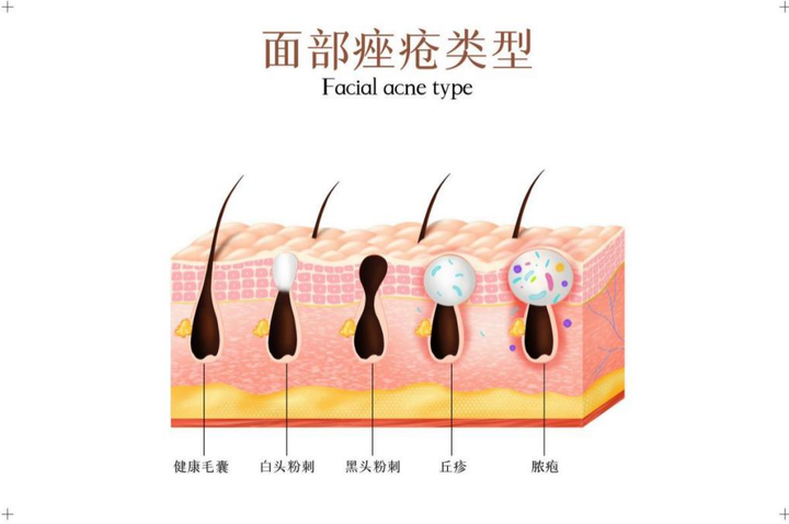 毛囊炎如何辨别?和痤疮傻傻分不清? - 知乎