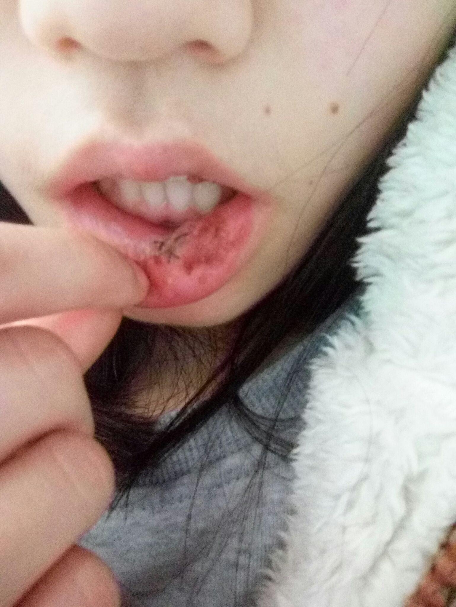 嘴唇内侧长了一个米粒样的突起消不掉好像是什么粘液腺囊肿去医院应该