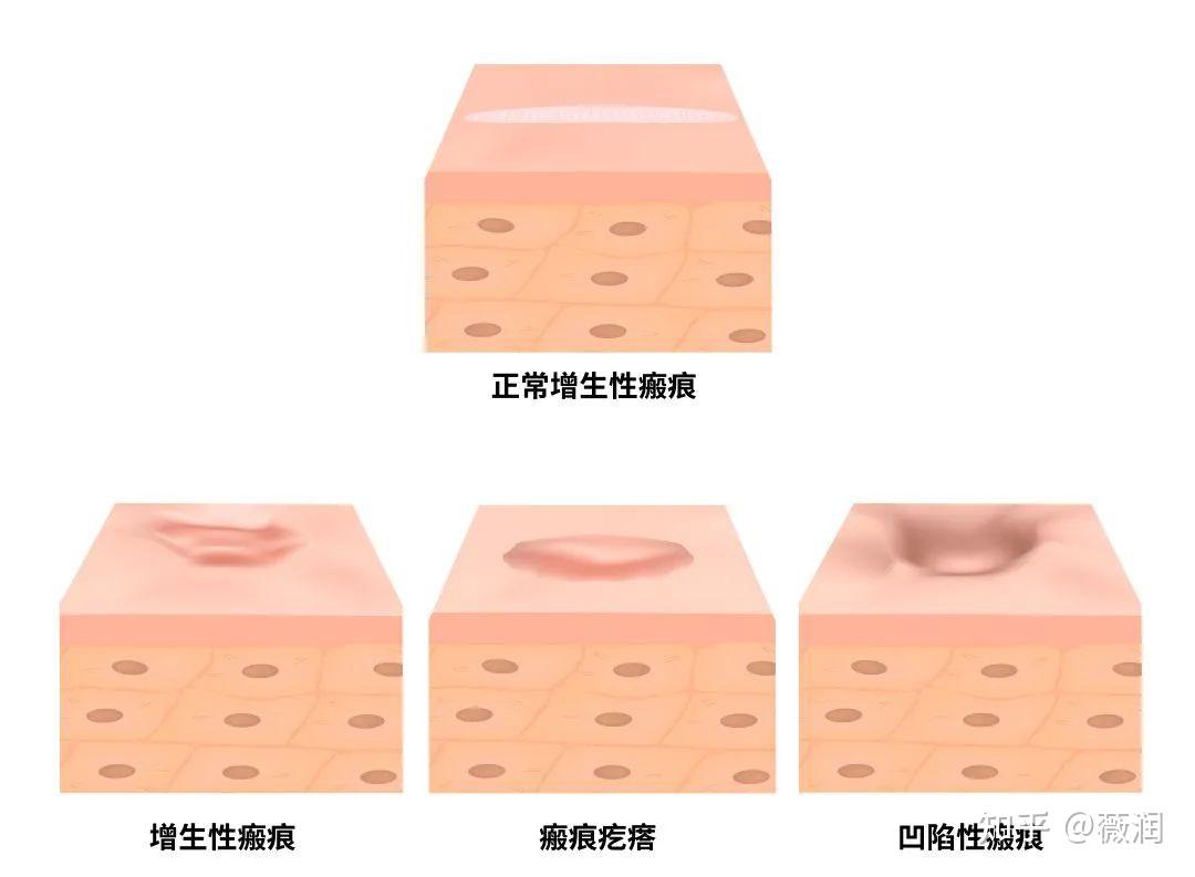 影响美观增生性瘢痕，重组Ⅲ型人源化胶原蛋白减少增生性疤痕形成 - 知乎