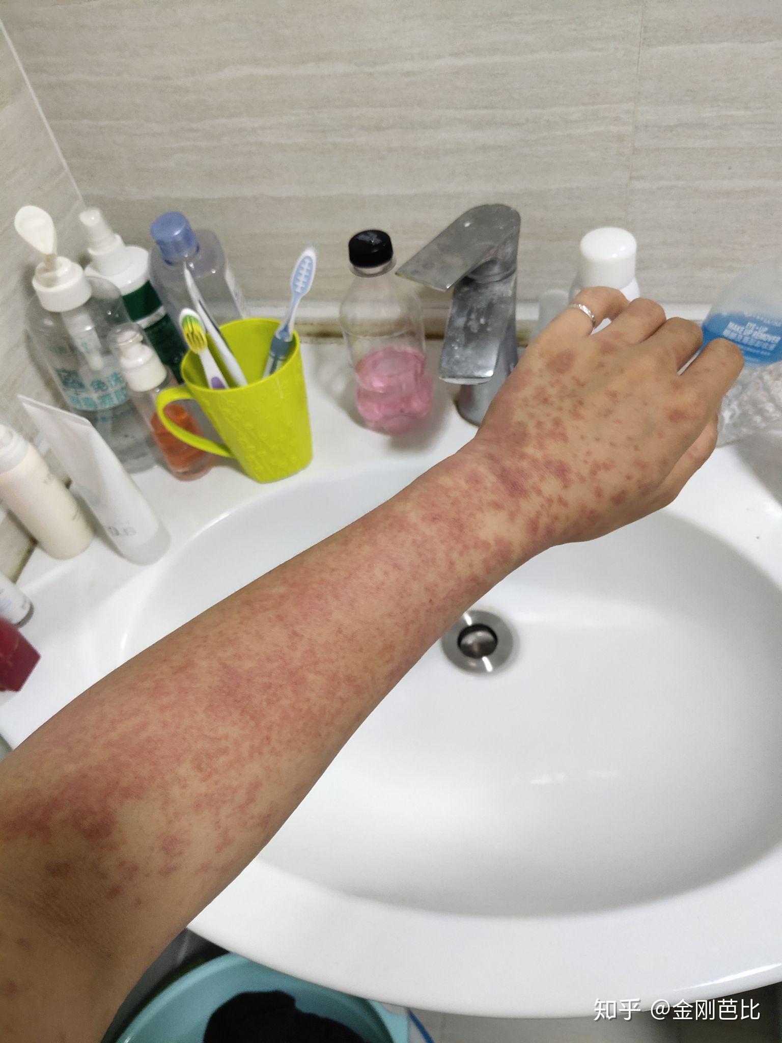 得了多形性红斑,怎么才能痊愈啊?要忌什么吗? - 知乎