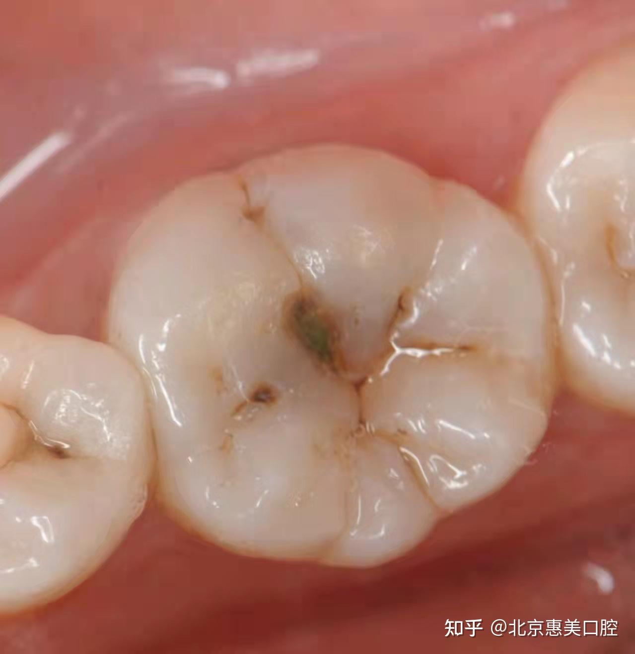 良乡补牙 该多少钱一颗? - 知乎