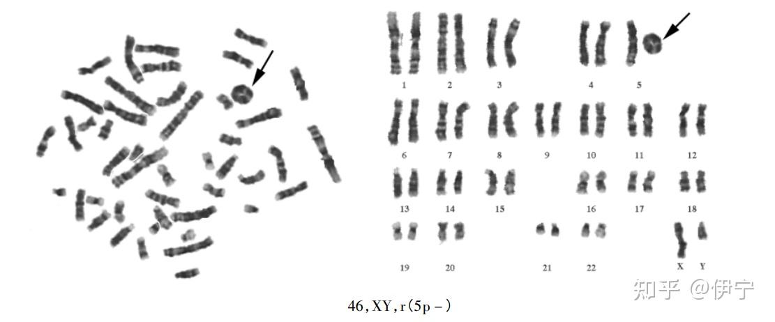 确诊猫叫综合征的孩子长大后一定会是先天愚型吗?
