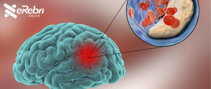 有效减少脑缺血再灌注造成的神经损伤