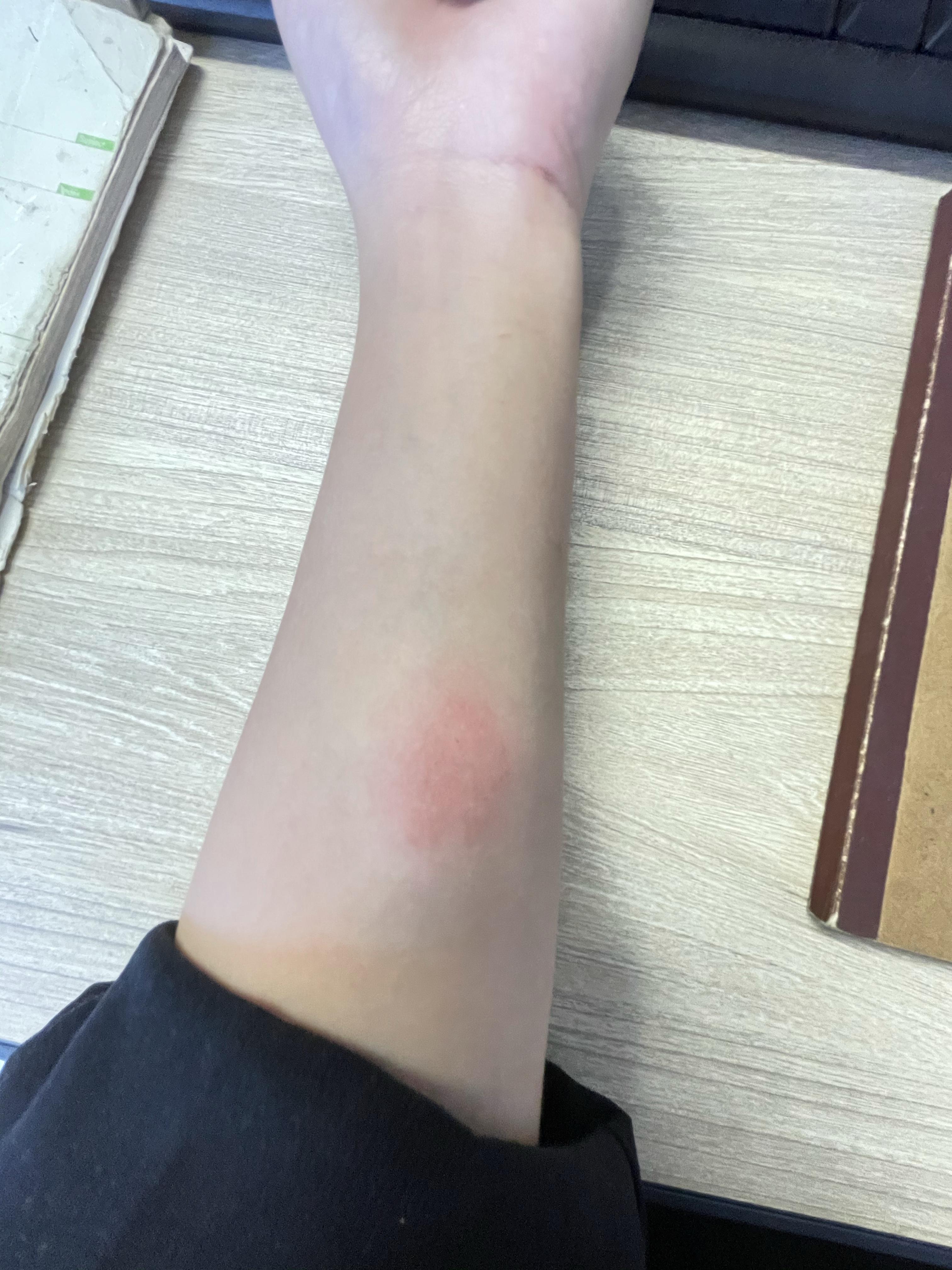 结核皮试起了个大水泡,破了怎么办? - 知乎