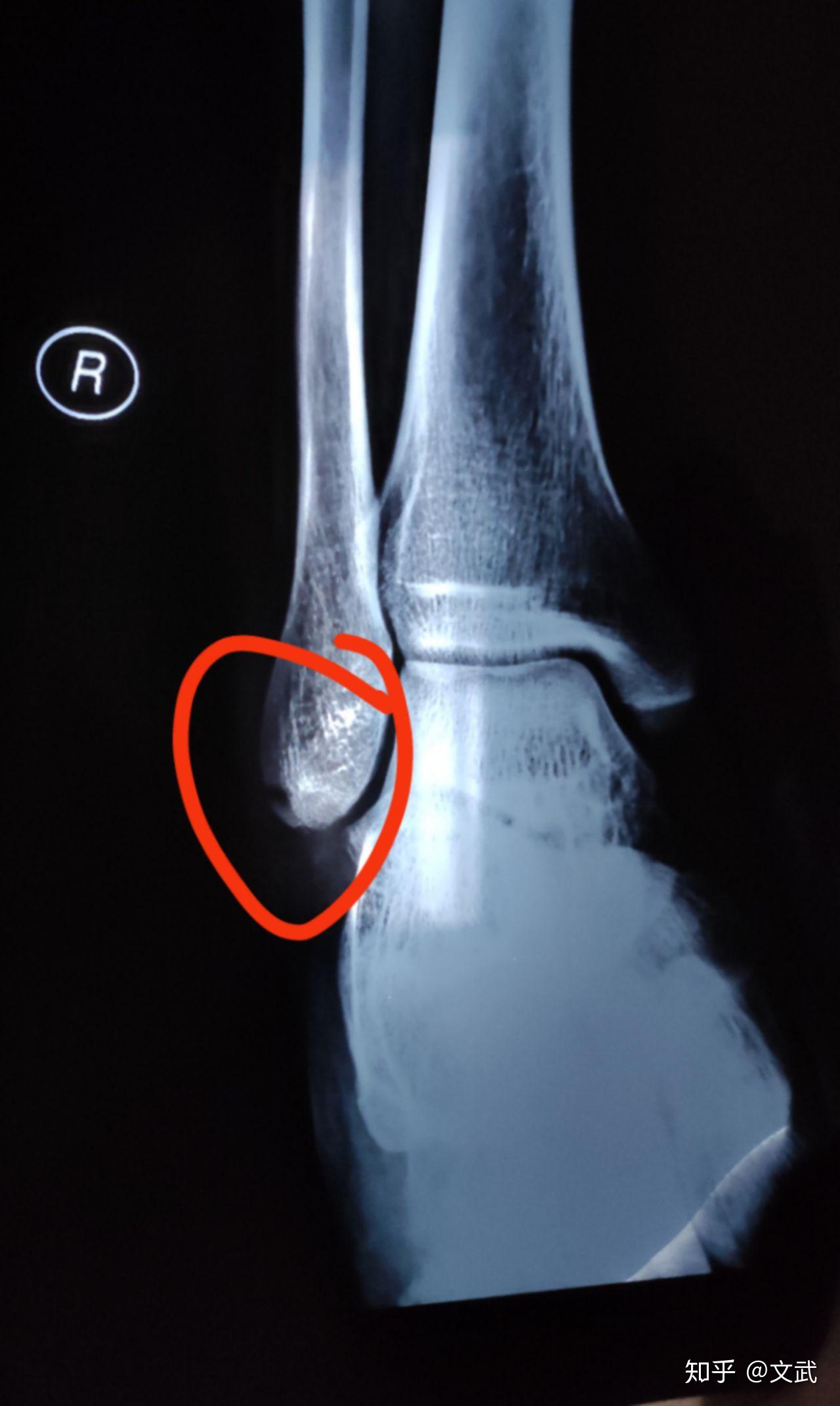 脚踝腓骨撕脱性骨折多久可以下地走路