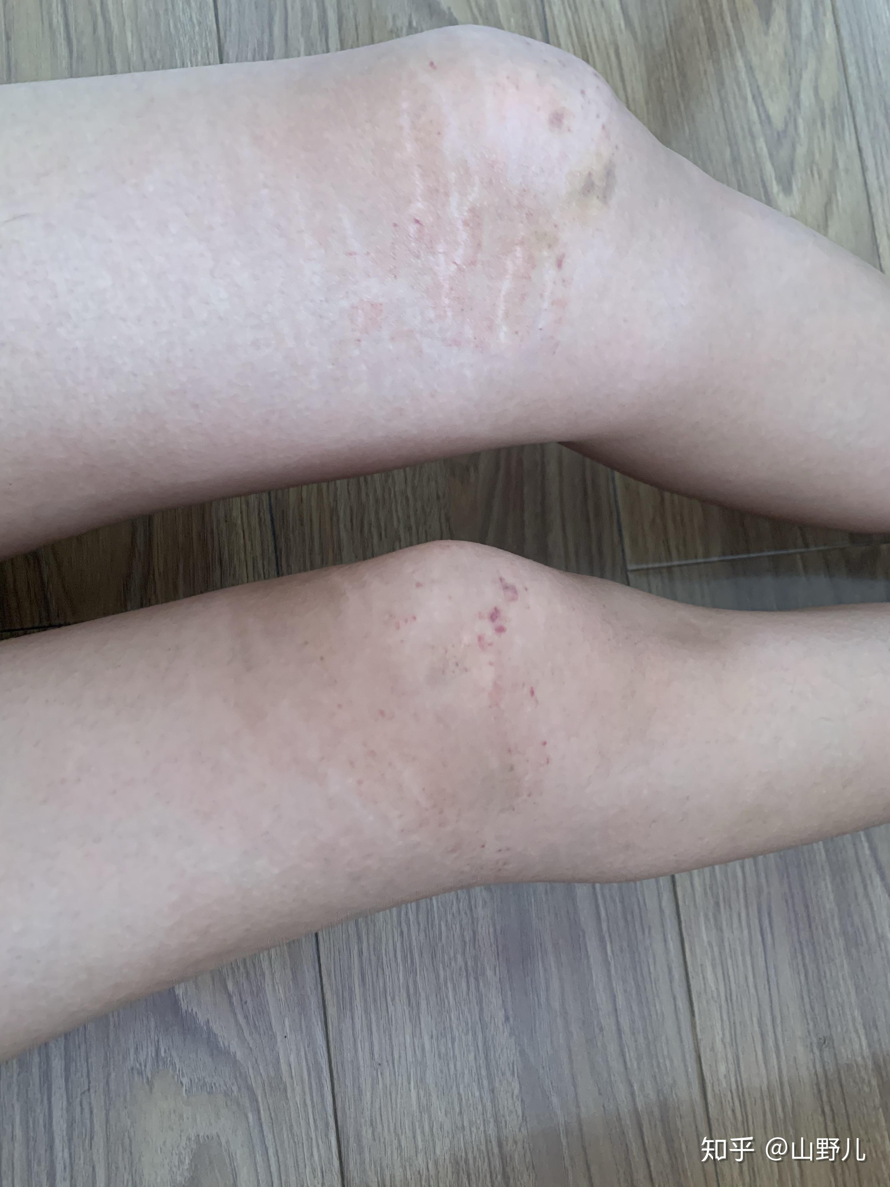 生长纹/肥胖纹(白色的有点波浪线的)有淡化成功的么? - 知乎