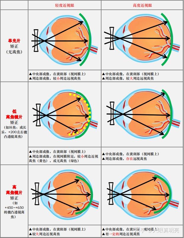 离焦镜片的离焦量越大,控制效果就越好吗? - 知乎