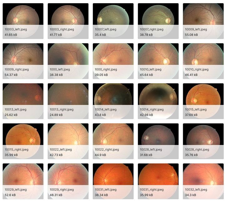 neuroretinopathy图片