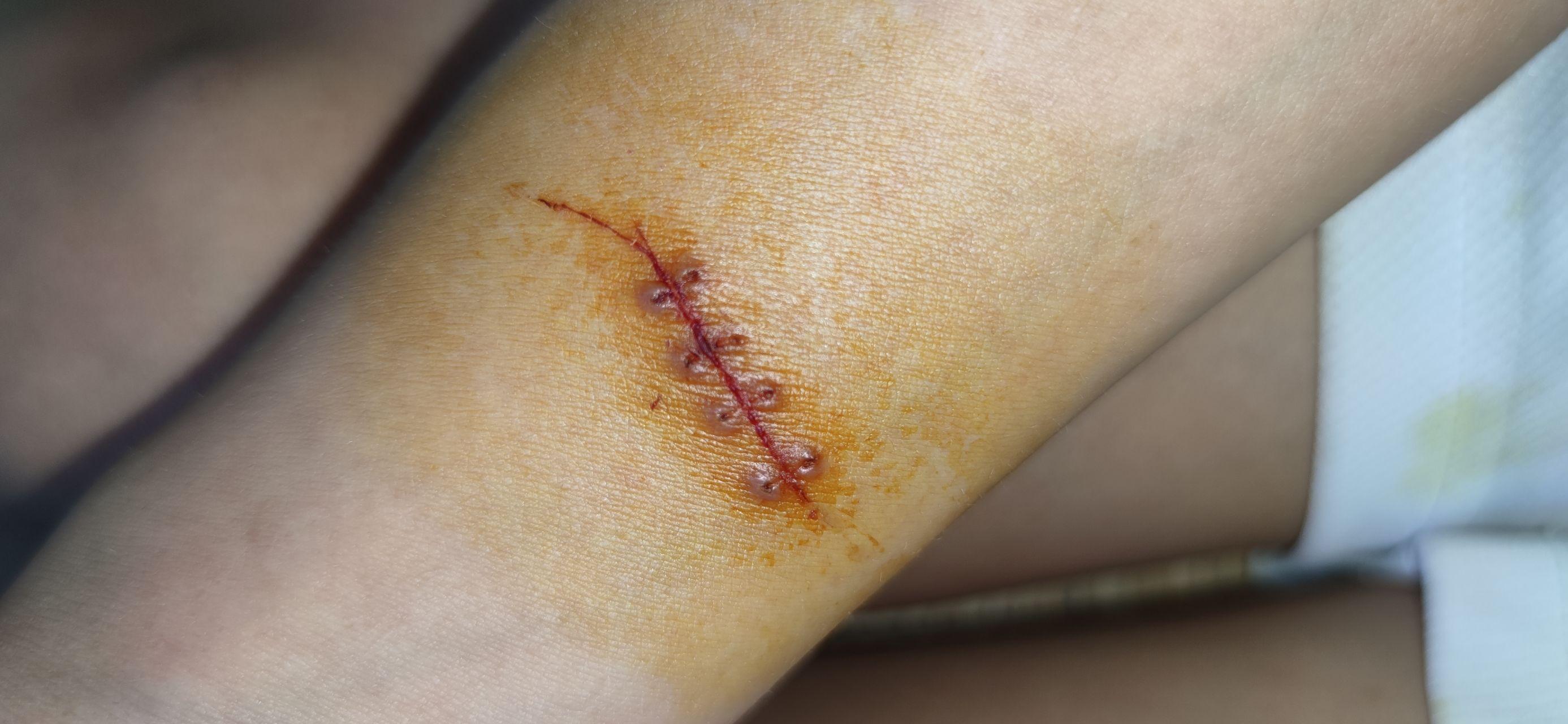 手术缝合伤口能修复到什么程度?
