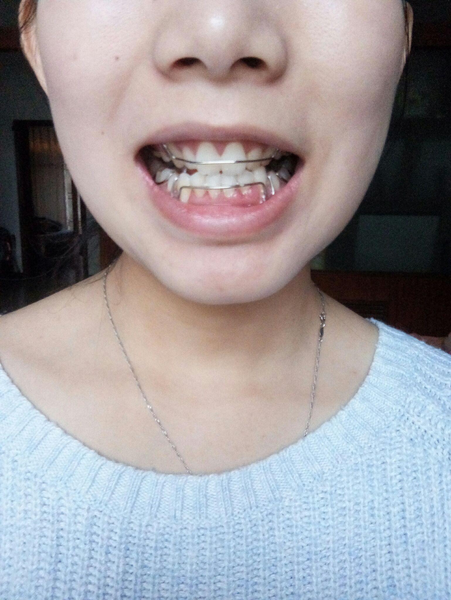 ​ 写回答 登录/注册 牙齿 牙齿正畸 x是种怎样的体验 牙不齐(倾斜