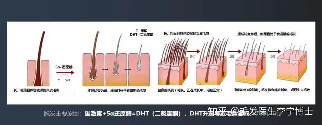 如何抑制或减少DHT生成? - 知乎