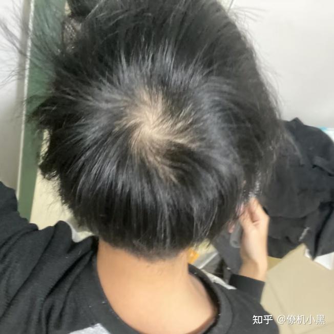 发旋处头发太少了！！！，我是不是要秃了，怎么办啊！？ - 知乎