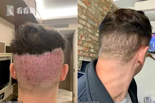 见过的最大头皮屑多大