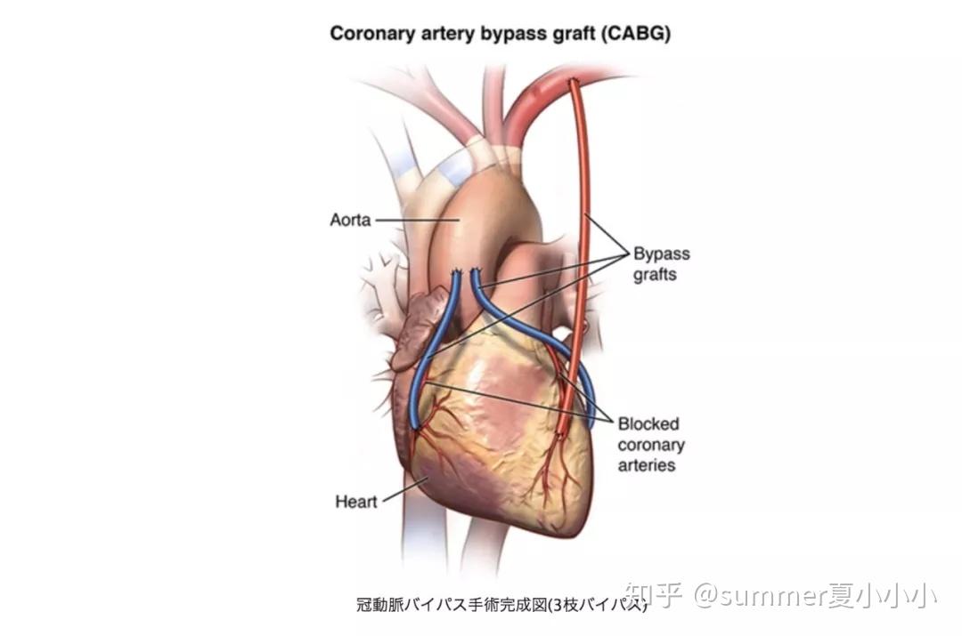 心脏搭桥手术图解图片