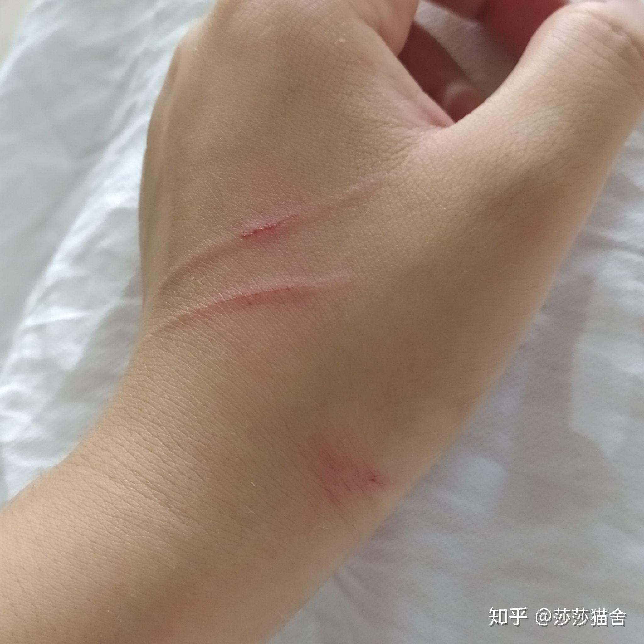 被猫抓出血这种程度需要去打疫苗吗