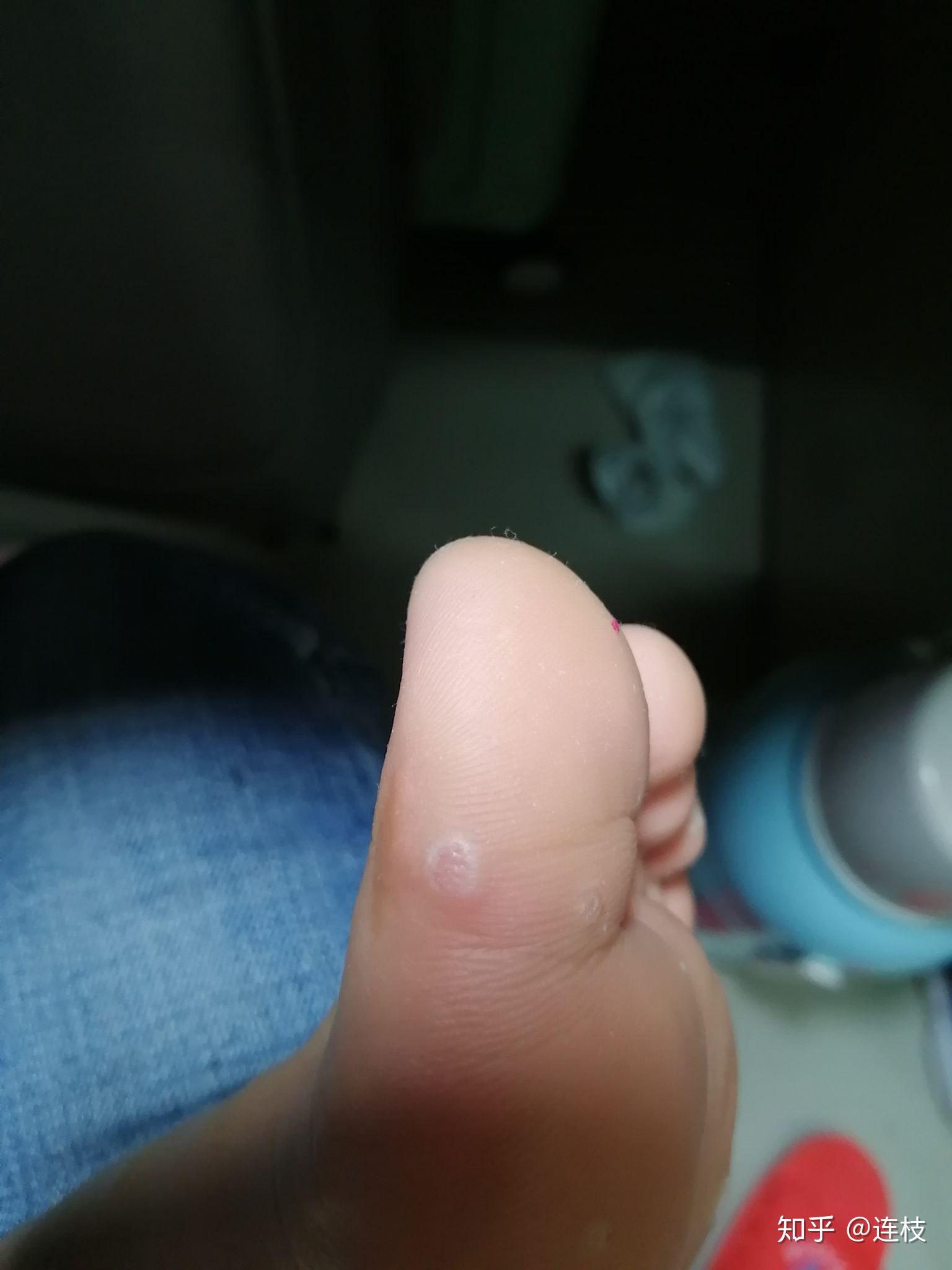 脚上感染长了疣怎么弄
