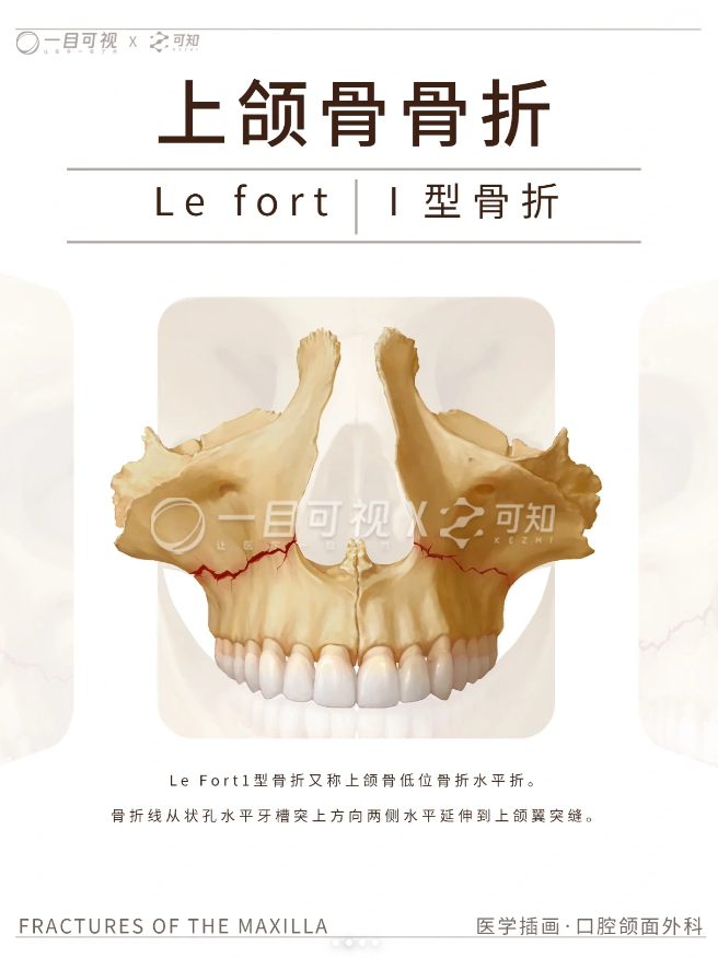 上颌骨骨折分型 - 知乎