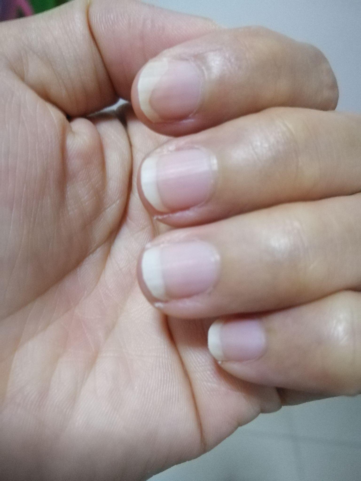 手指头月牙白是否真的能够反应人体健康状态