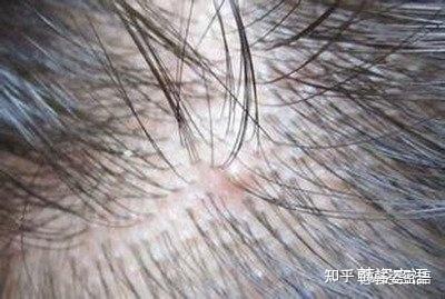 头皮科普篇|为什么要做头皮排毒?健康头皮从何而来? - 知乎