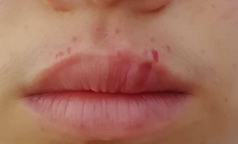 嘴唇上最近长了几个黑点 像痣又像斑 怎么能去除? - 知乎