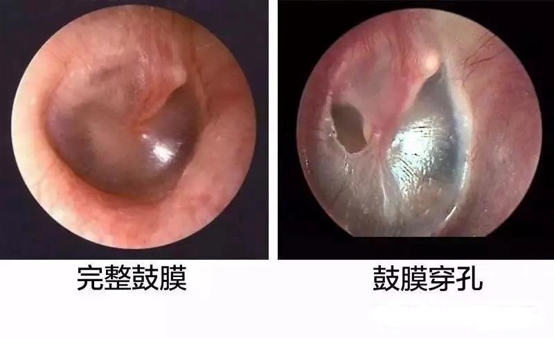 招飞体检常见鼓膜病变菲薄钙化穿孔内陷混浊充血