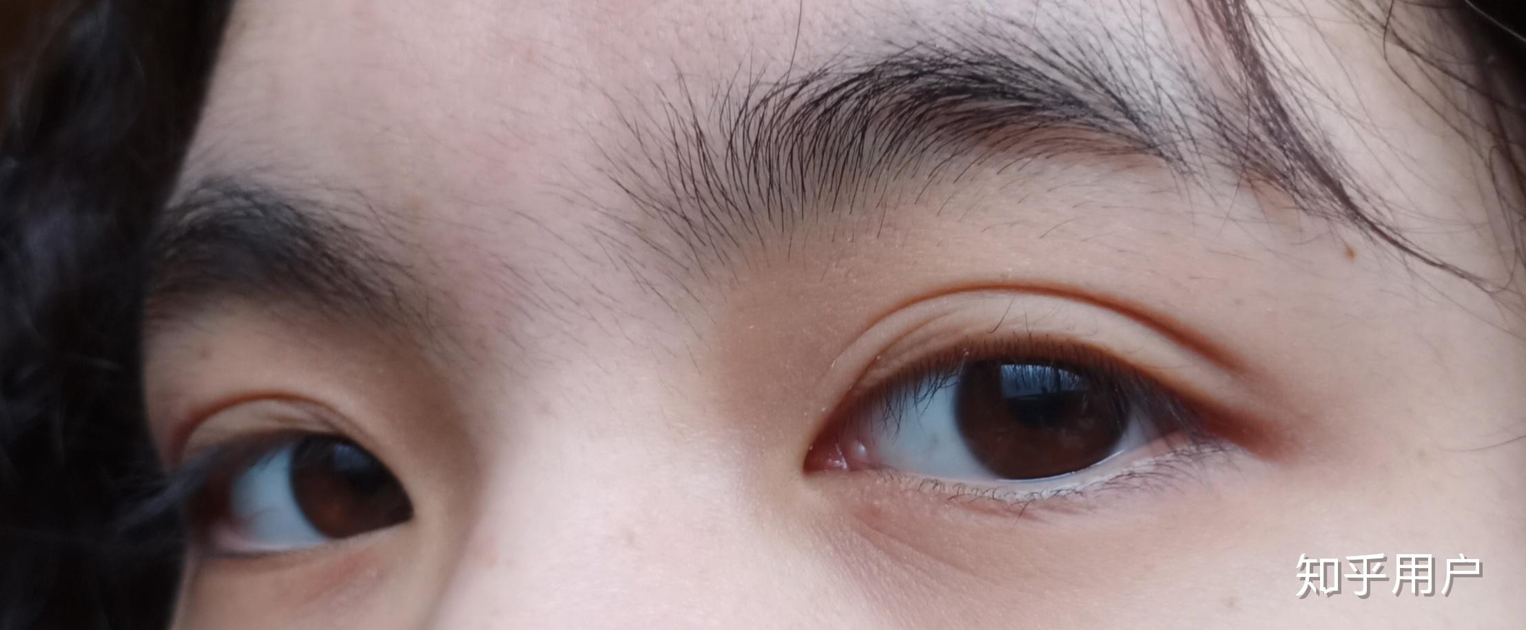 什么是蒙古褶? - 知乎