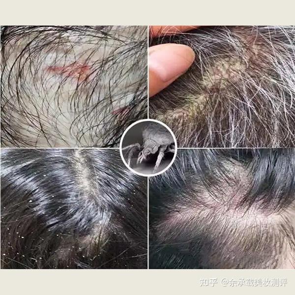 头皮干起头皮屑用什么洗发水?青少年去屑洗发水推荐 - 知乎