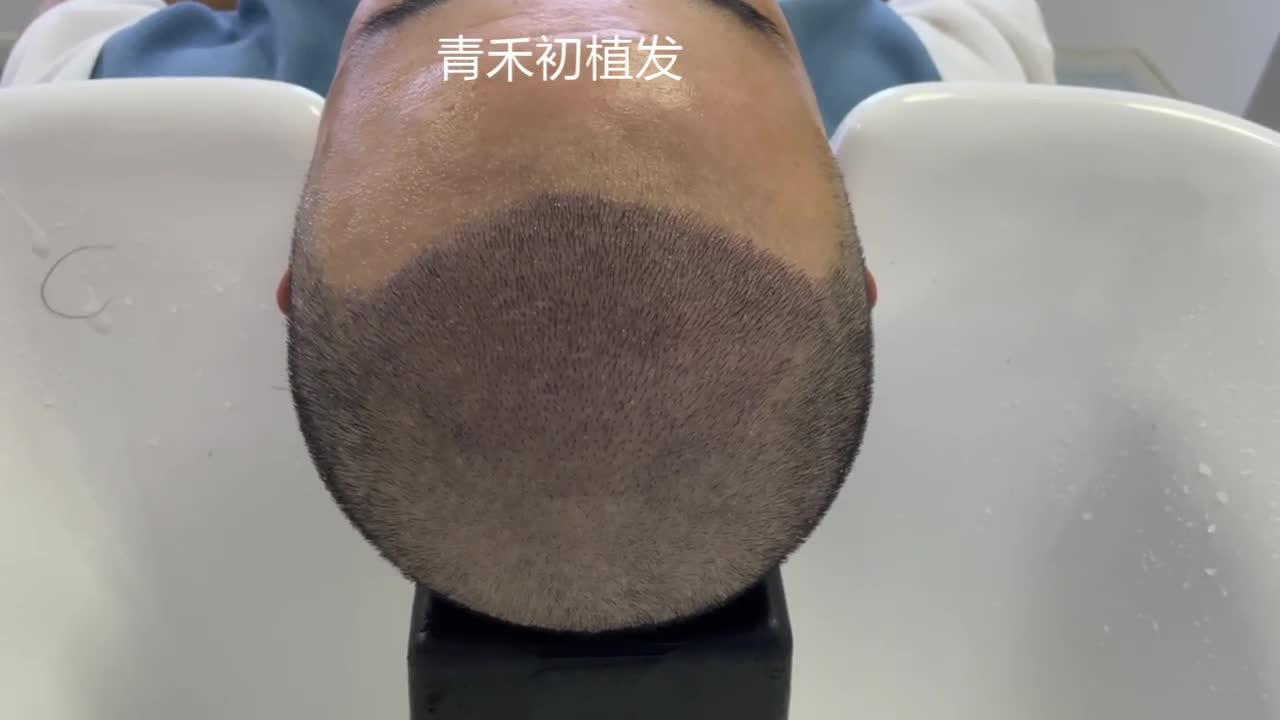 陕西省植发(西安的植发医院)