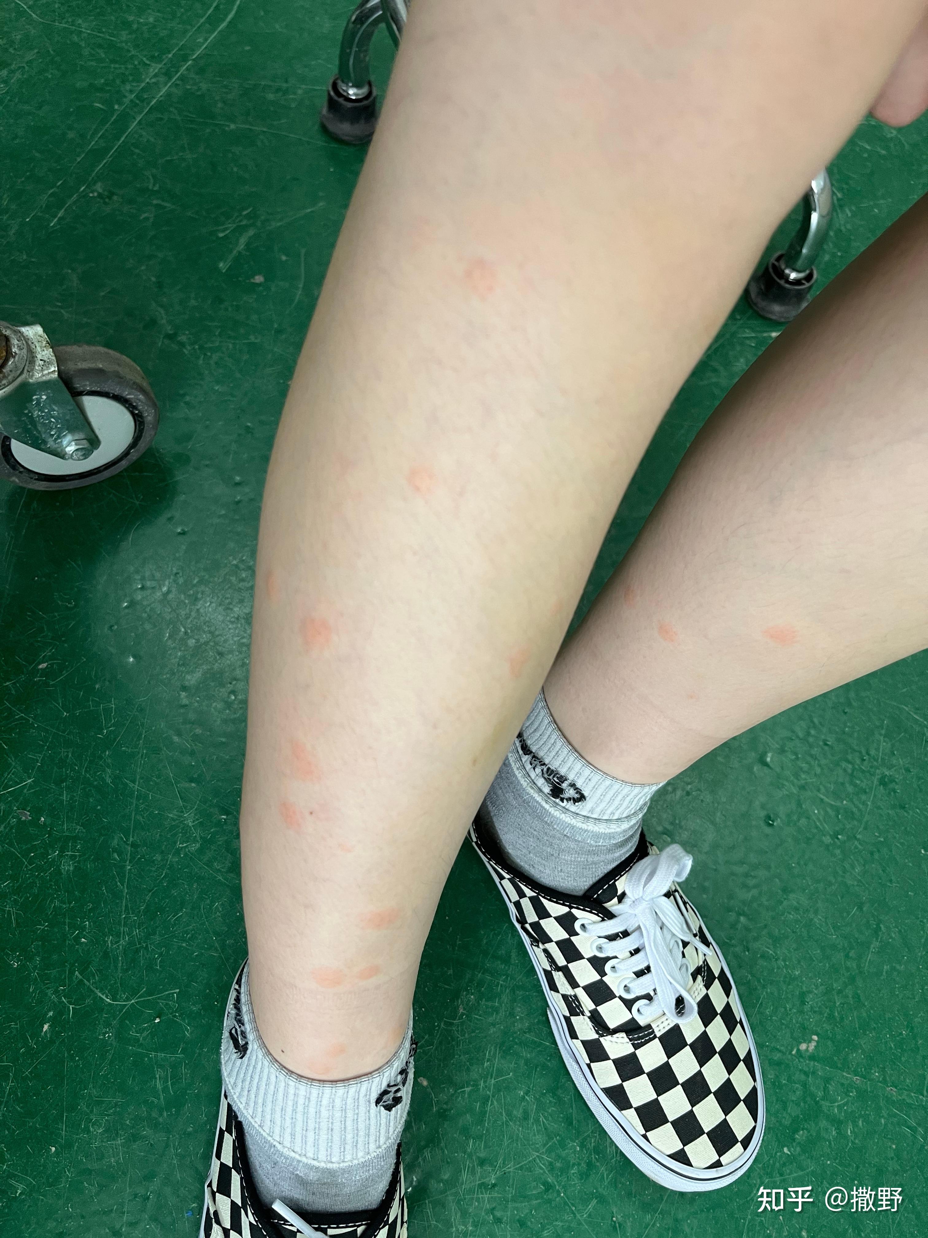 蠓一种很难发现的小黑蚊被折磨了好多年了昨天出门又被咬到又痛又痒