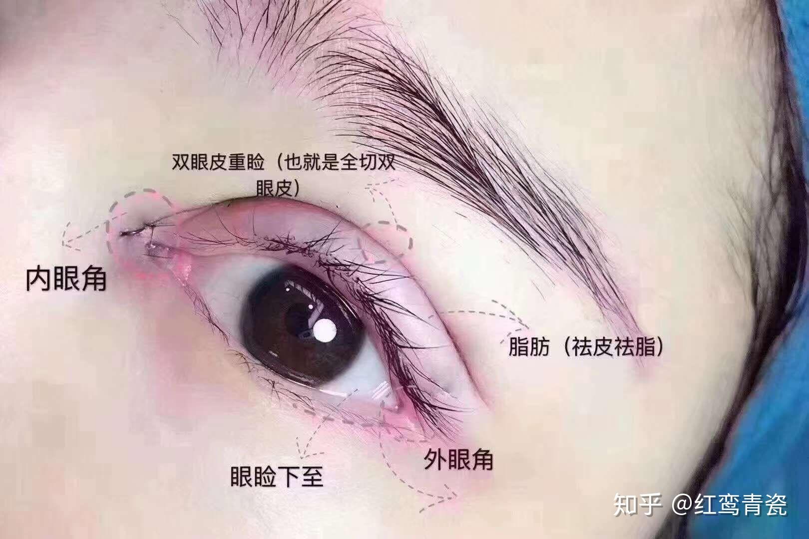 北京全切双眼皮+上睑下垂矫正效果分享 - 知乎