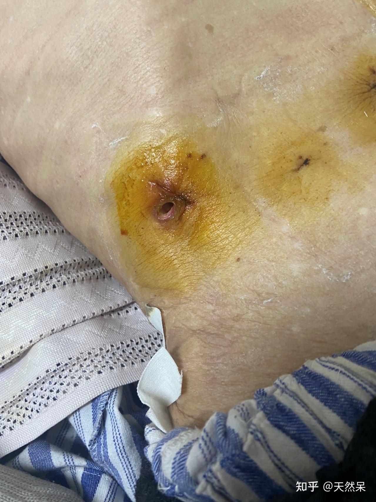 得胃癌是种怎样的体验? - 知乎