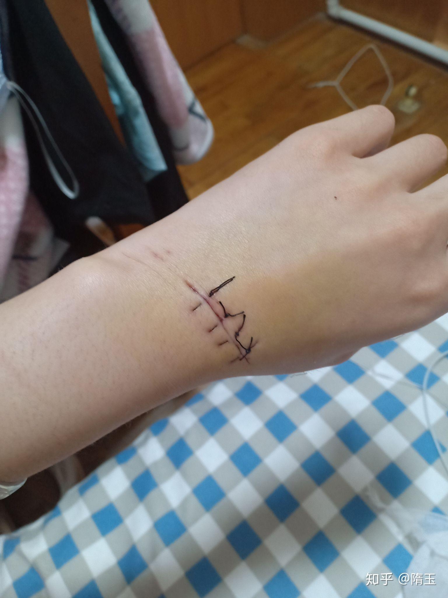 自残是可以停止的吗?