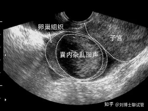 巧克力囊腫和多囊卵巢的區別