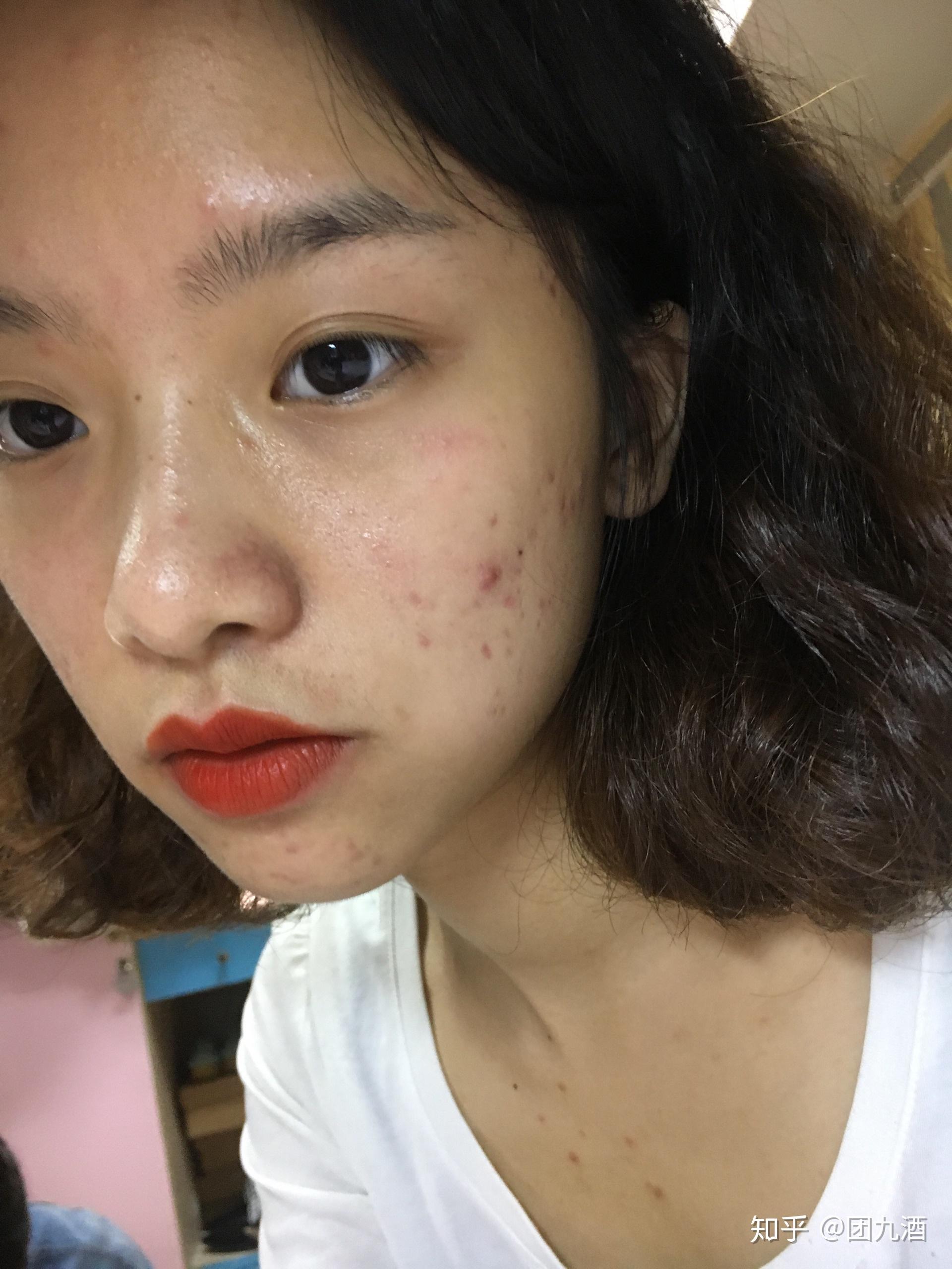 怎么看待五官漂亮但是皮肤差的女性? - 知乎