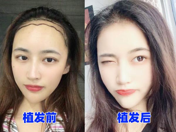 女生 发量少 头顶快秃了 有没有什么好的生发方法!跪求!