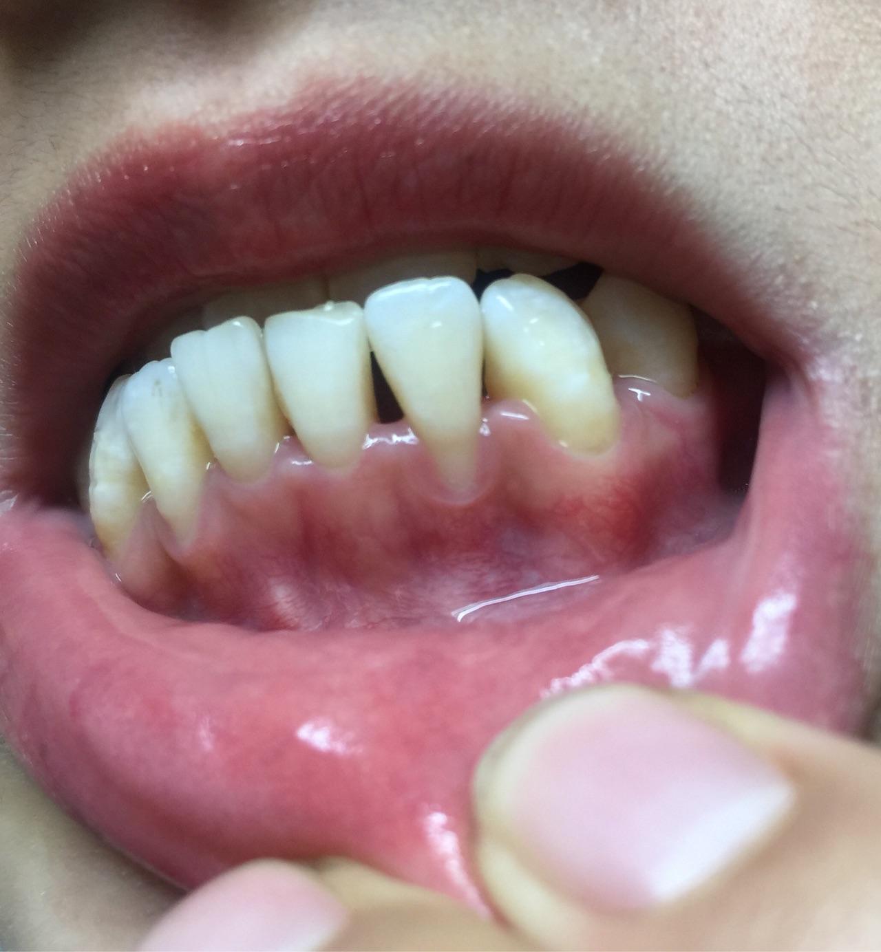牙龈萎缩适合做牙齿正畸吗