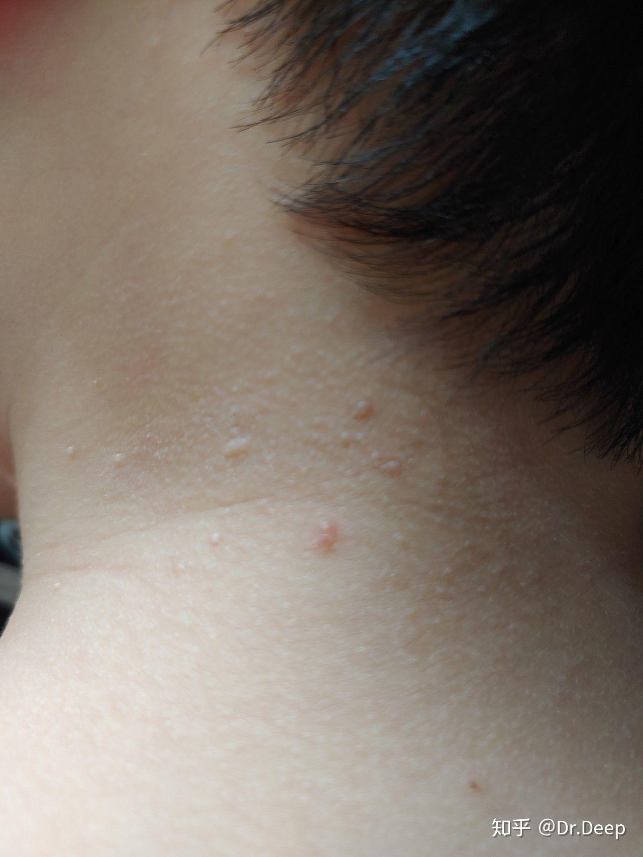 儿童传染性软疣能否自愈,会不会长到眼睛上,造成不可逆的损伤? 