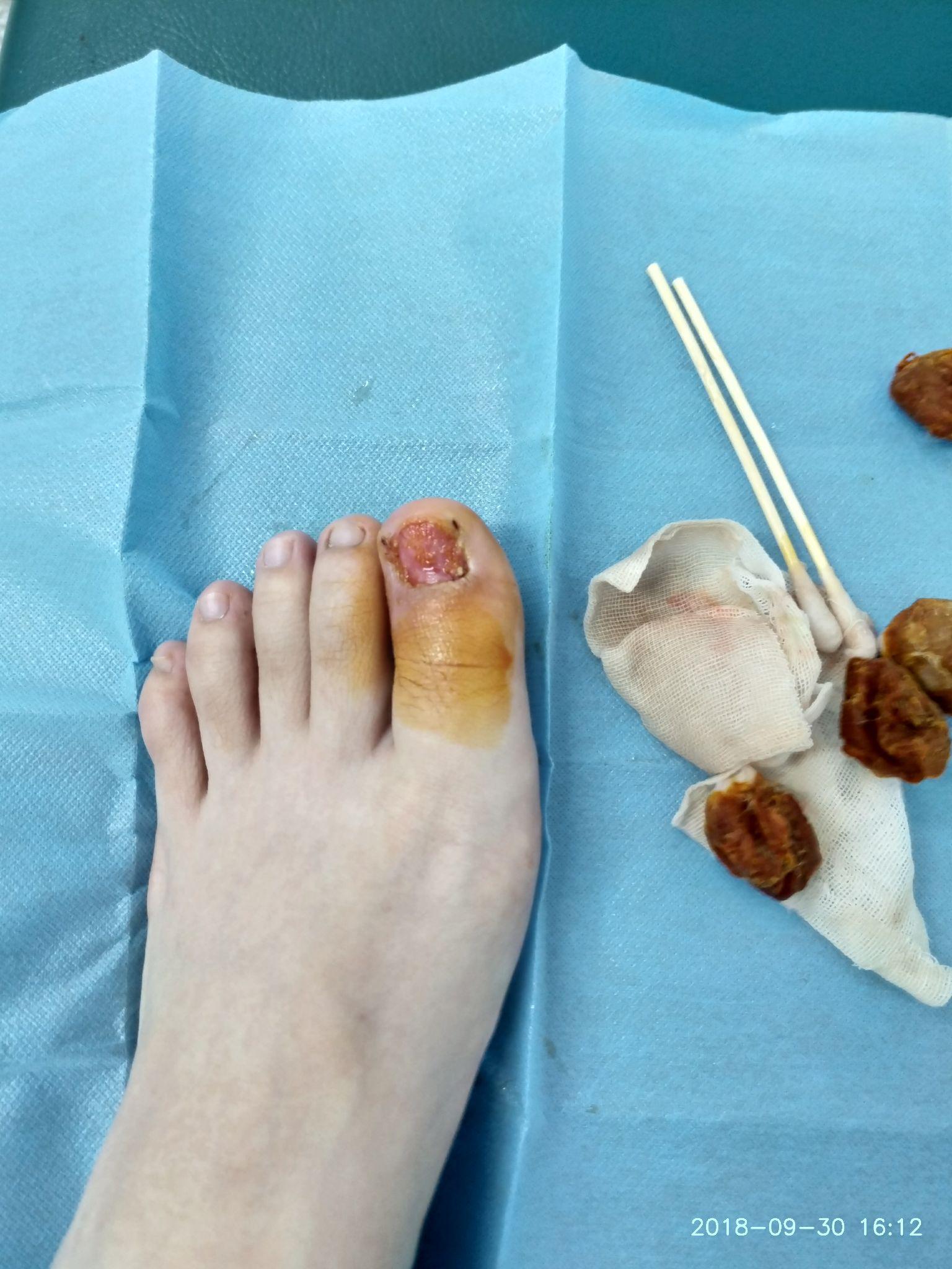 甲沟炎拔甲是怎样的体验