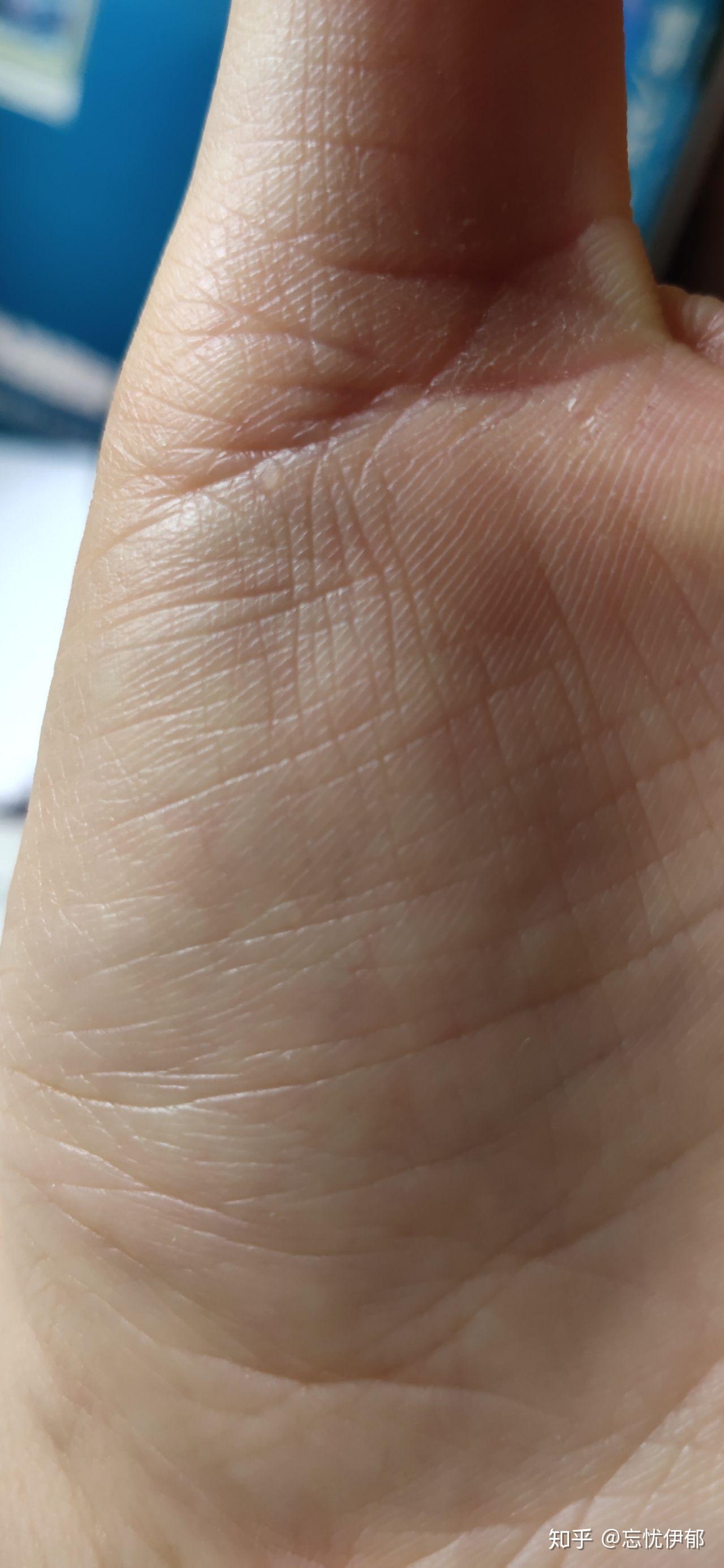 手部皮肤上长了透明小包(小疙瘩),不痛不痒,微硬,请问这是什么?