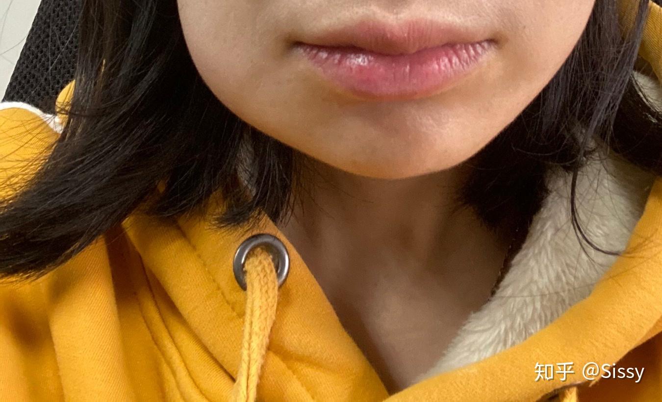 拔智齿24小时.脸肿成包子.多久才能恢复? - 知乎