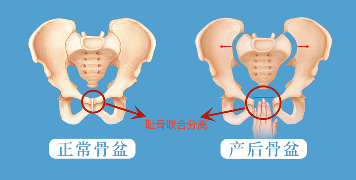 耻骨分离的症状图片图片