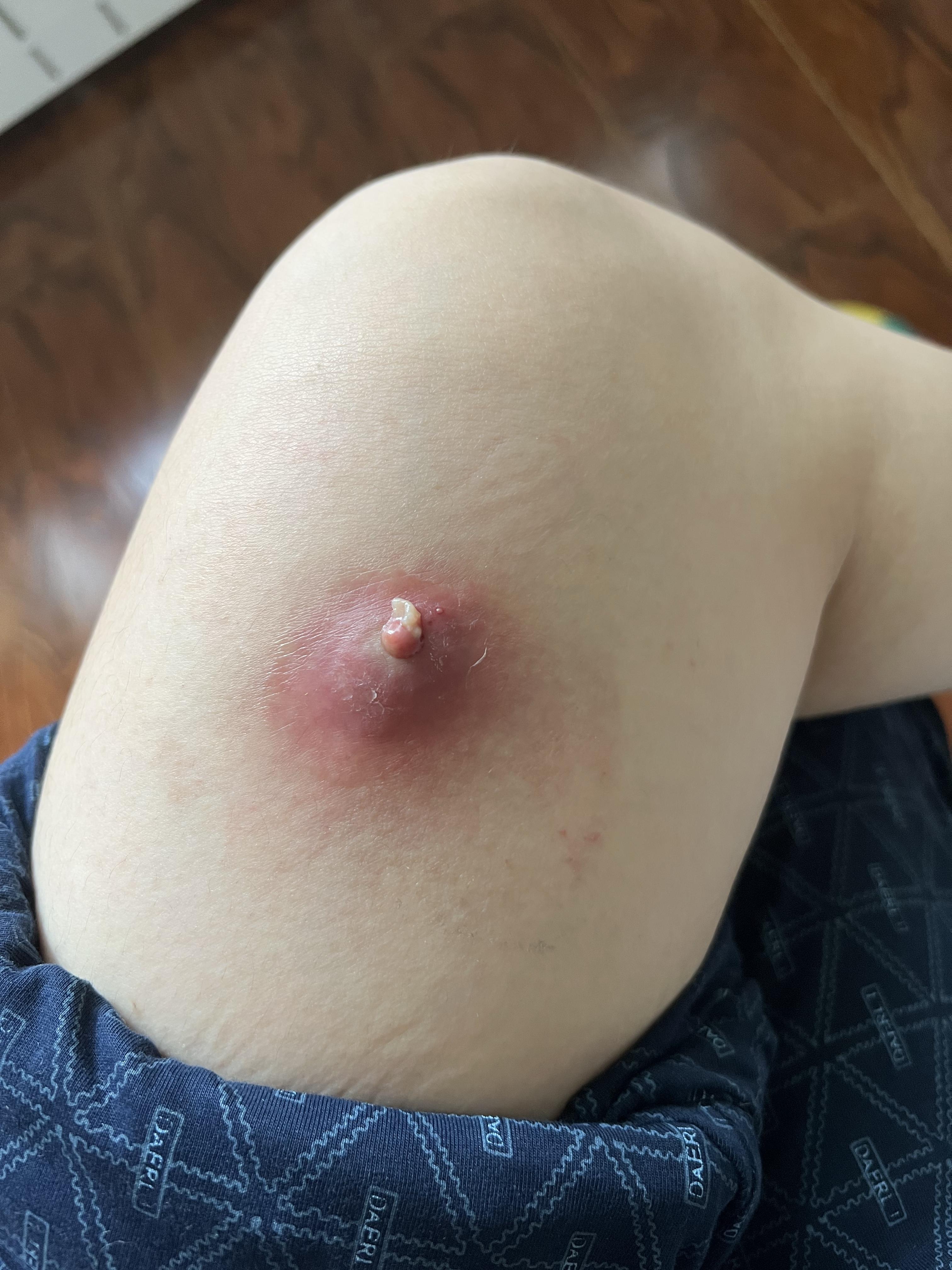 人体的火疖子 (化脓性毛囊及毛囊深部周围组织的感染) 能有多大?